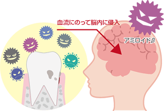 アミロイドβが脳に蓄積するイメージ図