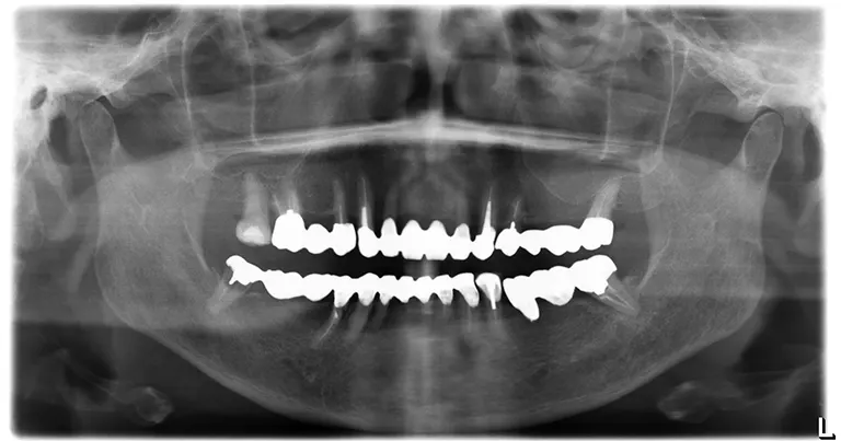 インプラント治療前の状態