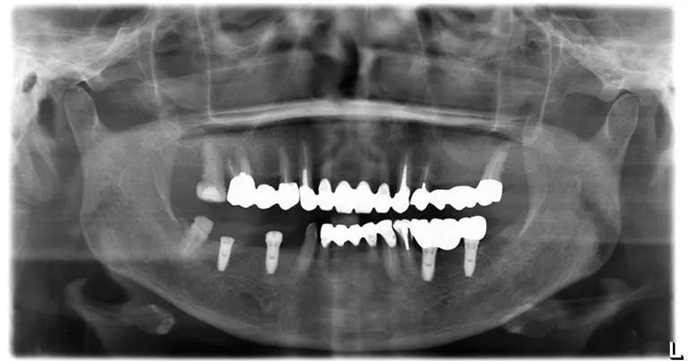 インプラント埋入