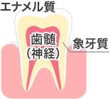 初期の虫歯(C0～C1)