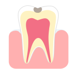 中程度の虫歯(C2)