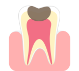 進行した虫歯(C3)