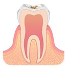 軽度の虫歯 C1
