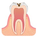 中程度の虫歯 C2