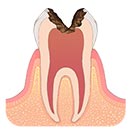 重度の虫歯 C3