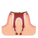 重度(末期)の虫歯 C4